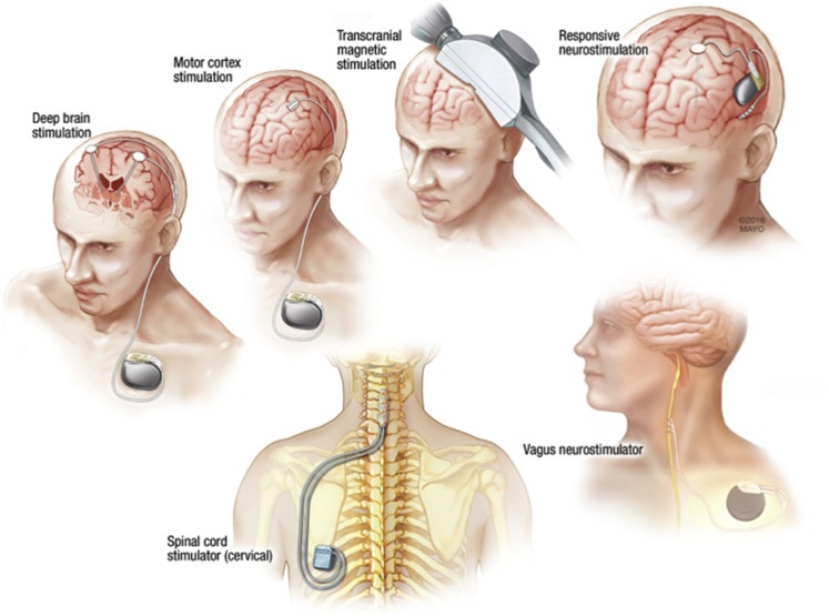 https://integratedpain.com/wp-content/uploads/2018/09/Auricular-Electrical-Percutaneous-Neurostimulation-Therapy%E2%80%8B.jpg